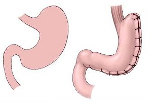 <strong>GASTRIC PLICATION</strong> 